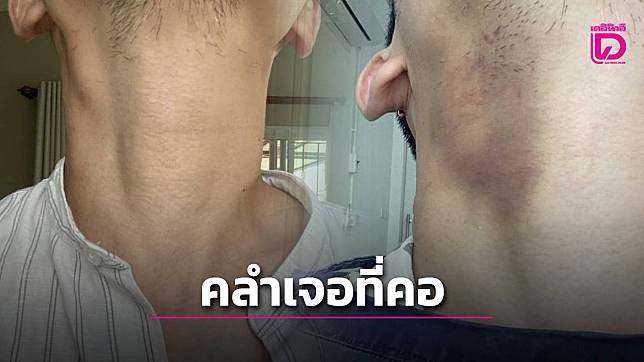 ‘หมอฟัน’ เล่าเมื่อต้องกลายเป็นผู้ป่วย คลำเจอก้อนที่คอก่อนเจอโรคร้าย