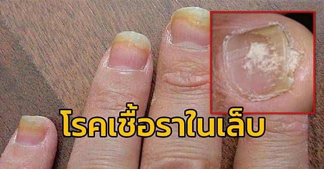 โรคเชื้อราที่เล็บคืออะไร และมีวิธีการดูแลรักษาอย่างไร