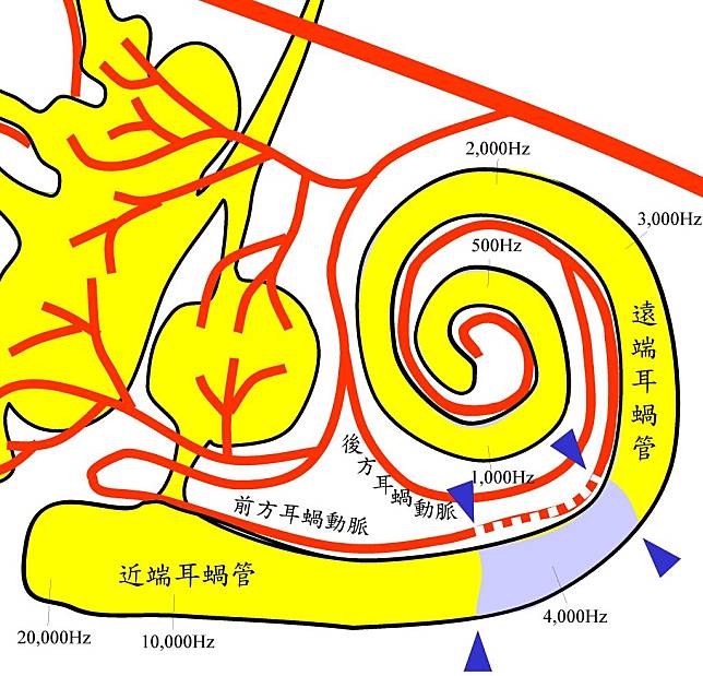 右下藍色箭頭所指紫色段落乃耳蝸管4000Hz處，是近端段耳蝸管動脈與中央段耳蝸管動脈的交界處，因血脂質過高引發病變。（醫師陳建志提供）