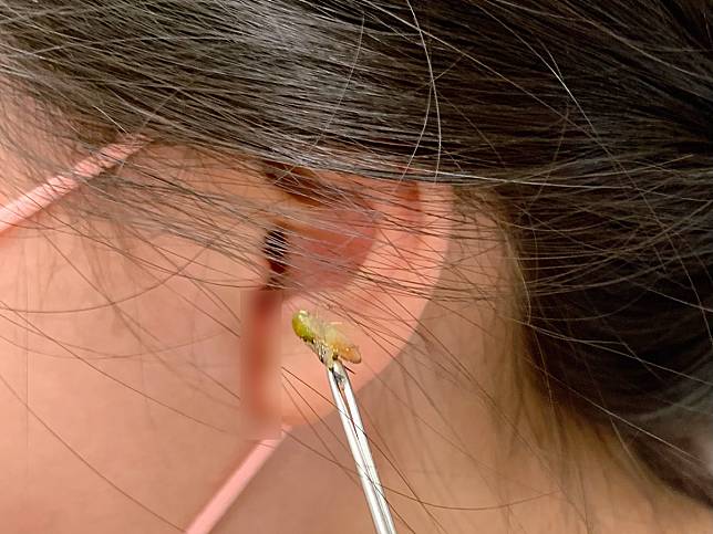 一名國小女學童日前發生耳朵有小蟋蟀誤闖，經耳鼻喉科醫師以耳鏡檢查取出。（圖：醫院提供）