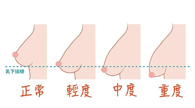 萊佳形象美學診所張智皓醫師指出，許多女性在產後為何會面臨乳房萎縮、外擴或下垂的情況。