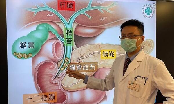 有膽結石一定要開刀嗎？　最新膽管內視鏡就可擊碎「巨石、頑石」