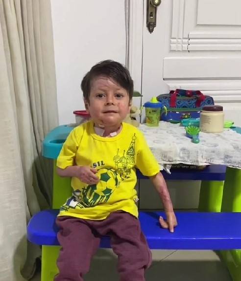 8歲男童Guilherme Gandra Moura自小就患有罕見疾病「遺傳性表皮分解性水泡症」。
