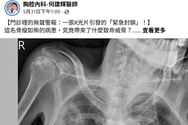 老翁的胸部X光片讓醫師緊急下達「隔離」指令。圖／胸腔內科-何建輝醫師FB