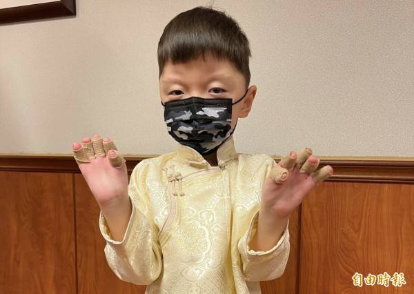 蒙古5歲男童Ochirs來台進行2次手術後，目前10根手指已順利分離，2年後將再來台再進行頭部手術。(記者許麗娟攝)