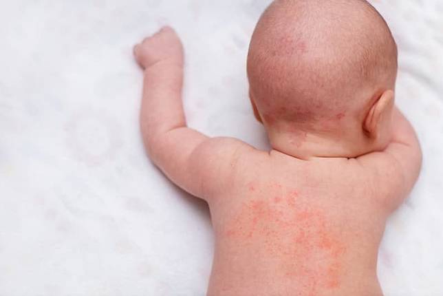 嬰幼兒脂漏性皮膚炎