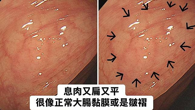 20歲女子罹患鋸齒狀息肉症候群，大腸內息肉超過20顆。翻攝林相宏臉書