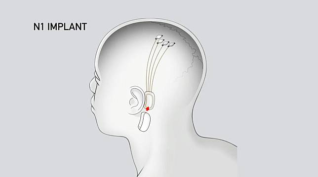 สรุป Neuralink: แผนของ อีลอน มัสก์ ที่จะทำให้คนกับคอมพิวเตอร์อยู่ร่วมกัน