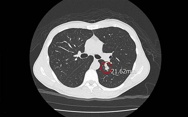 一名53歲男性肺部一顆2公分腫瘤，經切片確認是「球黴菌」感染。（圖／澄清醫院中港分院）