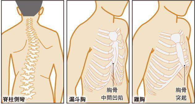 影響肋骨——肋骨突出、左右不對稱，可能是脊柱側彎、漏斗胸或雞胸的表徵。（明報製圖）