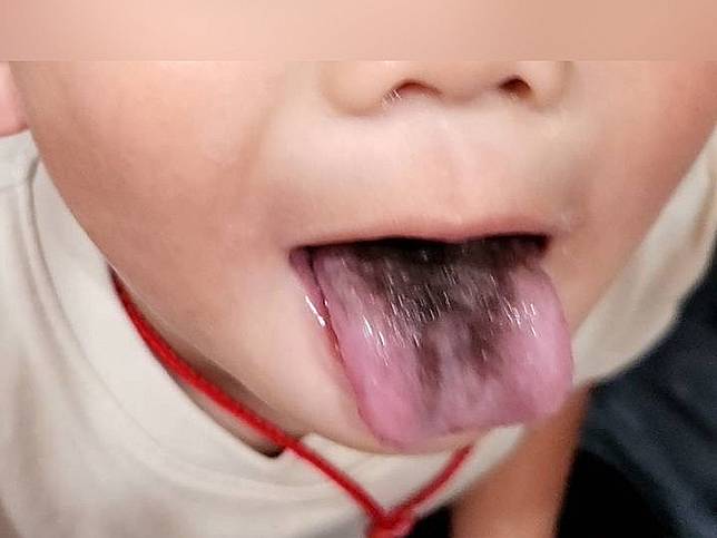 醫師說，「黑毛舌」較常出現在長期使用抗生素的人、吸菸者、口腔衛生不佳、或習慣使用刺激性漱口水的成人身上。（圖：光田醫院提供）