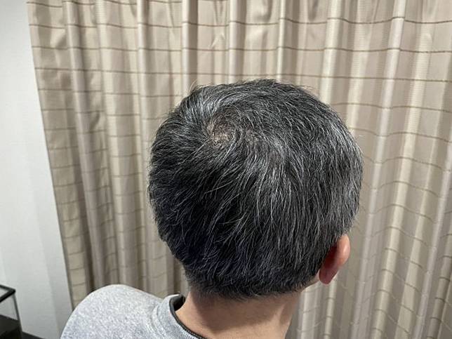 「一截黑一截白」是身體發出的求救訊號　研究驚曝白轉黑關鍵「7天恢復」。示意圖／Photoac