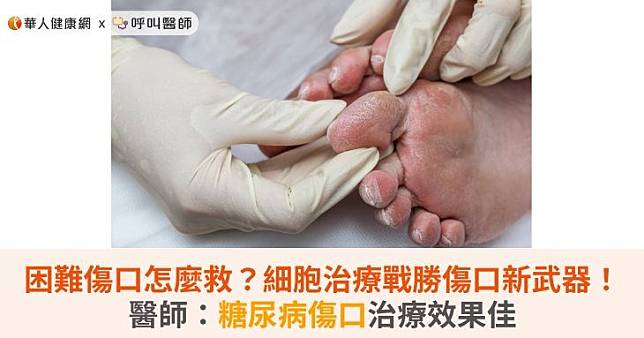 困難傷口怎麼救？細胞治療戰勝傷口新武器！醫師：糖尿病傷口治療效果佳