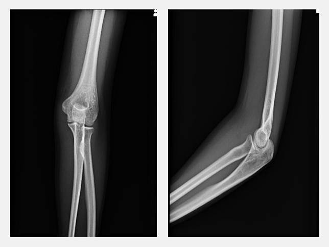 患者X光片顯示，手肘隧道症候群可能會在手肘部位引起疼痛。（記者徐義雄翻攝）