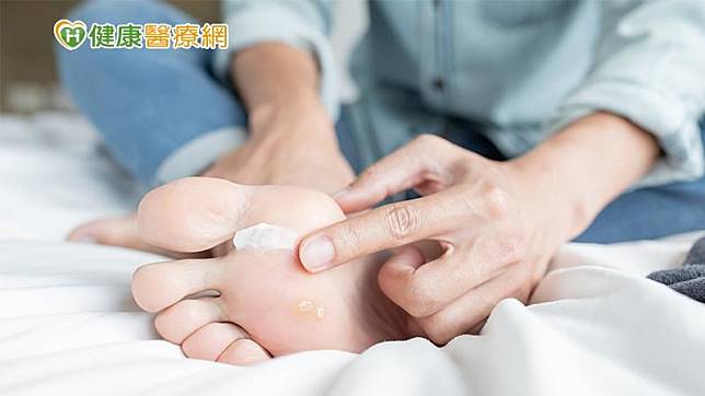 洪崧壬指出，香港腳的成因就是黴菌感染，黴菌喜歡在悶濕、悶熱的環境生長，民眾本身若有香港腳問題就會在這個季節更嚴重。