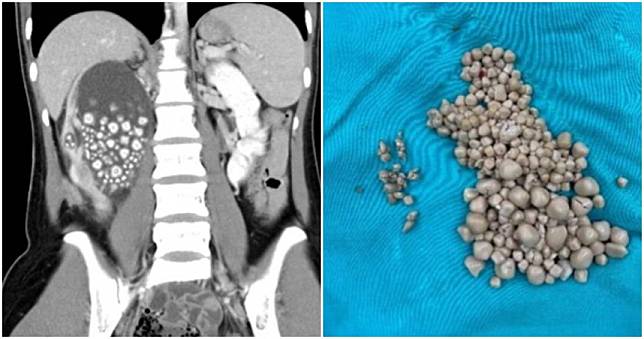 20歲女手搖飲當水喝…右腰痛到送急診　「300多顆結石」畫面曝光