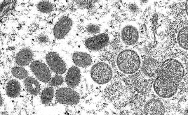 台灣首例猴痘確診 25歲男德國返台紅疹、鼠蹊部淋巴腫大