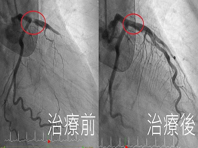 患者左前降支冠狀動脈阻塞高達99%，屬於極為致命的血管病變。（圖：亞大附醫提供）