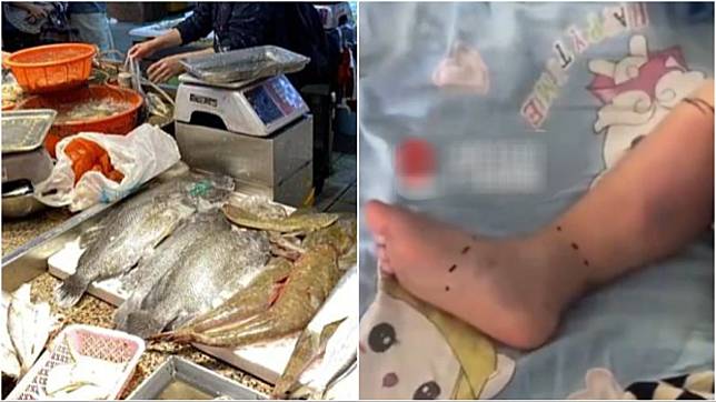 珠海2歲男童疑街巿接觸魚染致命菌，右腳發黑恐須截肢