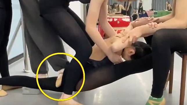 美少女張同學在「拉筋壓腿」訓練時，被老師踩斷腿骨。翻攝微博/四川遠倫教育舞蹈培訓機構事件
