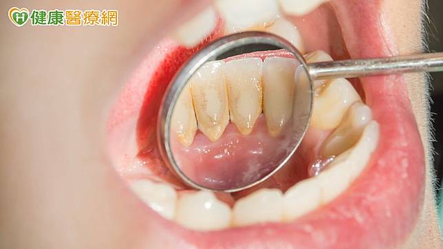 臺中慈濟醫院牙科醫師何曉涵解釋，造成「牙周病」，就是許多人熟知的牙菌斑累積引起，牙菌斑就是俗稱的「牙垢」。