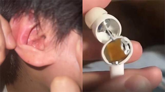 睡到一半耳邊傳巨響！中國「百萬熱銷藍牙耳機」瞬間爆炸　 男大生險失聰