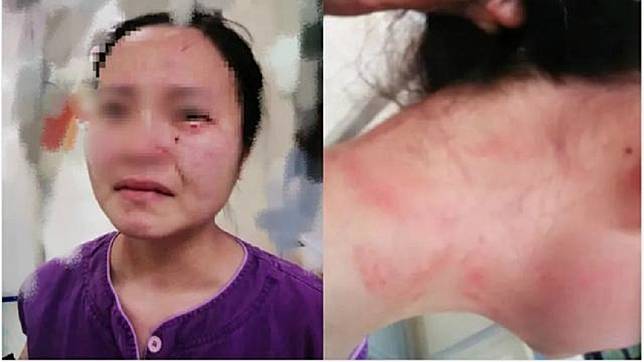 廣州1名護理師要幫1名確診新冠肺炎的外籍病患抽血時，遭對方一陣狂毆還咬傷臉部。(圖／翻攝自京報網)