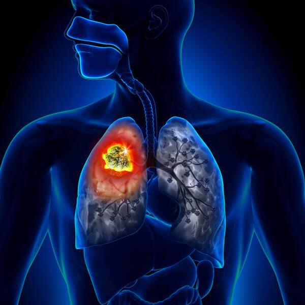 去年度國人十大死因，總計18萬4172人，以癌症致死人數最多，高達5萬1656人，其中最致命的肺癌繼續蟬聯18年致死人數榜首；圖為示意圖。(圖取自shutterstock)
