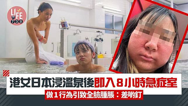 網上熱話｜港女日本浸溫泉後即入8小時急症室 做1行為引致全臉腫脹！