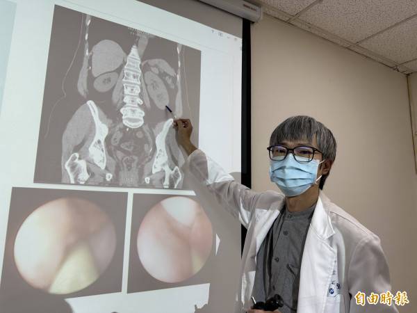 趙浩堅指出，張婦左側有兩顆腎臟及兩條完整的輸尿管，為「單側雙套集尿系統」，她先天有3顆腎臟。(記者蔡淑媛攝)
