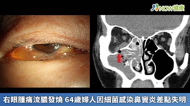 ▲醫師檢查該名婦人眼睛，發現竟是鼻竇炎引起的眼部蜂窩性組織炎。（圖／台北市立聯合醫院提供）