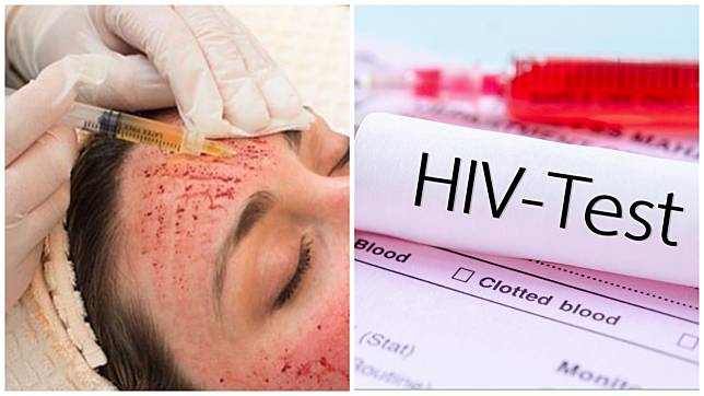美國首證實「吸血鬼療法」感染愛滋，成醫美注射傳播HIV病毒首例。