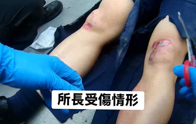 埔鹽分駐所所長陳國銘遭車輾過，造成右腳膝蓋骨裂、小腿骨折，緊急接受手術治療。(民眾提供)