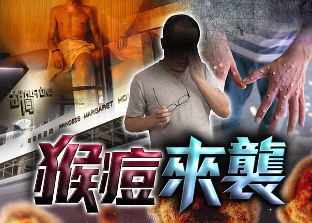 欲しいの 36歲漢染猴痘出水疱留瑪嘉烈醫院隔離治療| on.cc 東網| LINE TODAY 和書