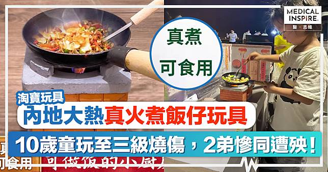 淘寶玩具｜內地淘寶大熱、真火煮飯仔玩具！10歲童玩至三級燒傷，2弟慘同遭殃！