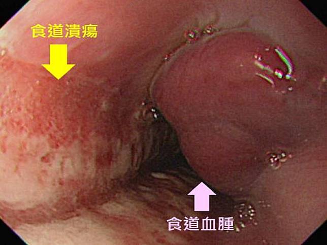 異物哽喉強想用「吞食法」解決　錯誤處理傷害更大