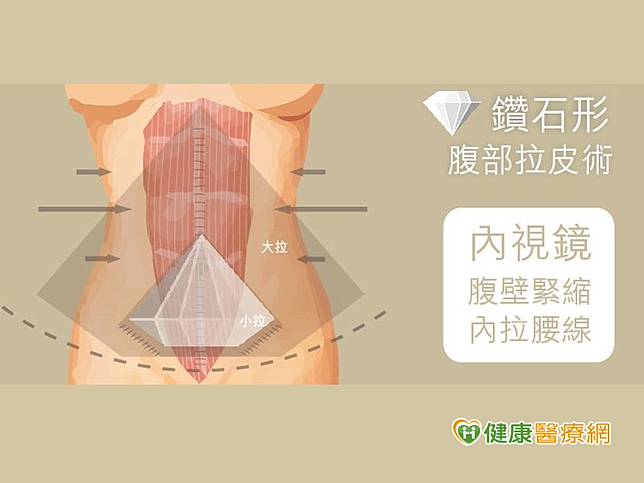 馮中和醫師解釋，產後婦女不少會倚靠超音波抽脂手術來雕塑變形的小腹，但當皮膚或肌肉過於鬆弛時，仍會有明顯的皺摺、鬆弛感及紋路，就必須要透過鑽石形雙層腹部緊緻拉皮手術來進行改善。